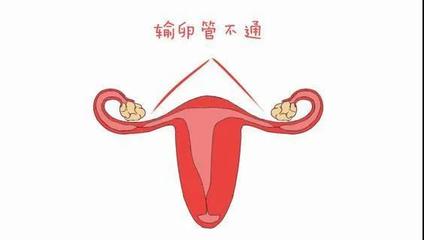 输卵管不通是怎么回事