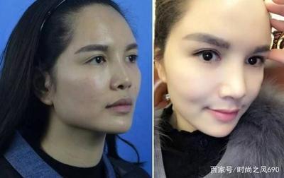 瘦脸针打50单位少了吗