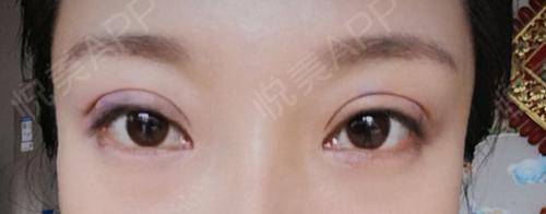 双眼皮和眼袋可以一起做吗