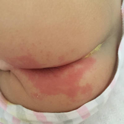 宝宝发烧过后拉肚子