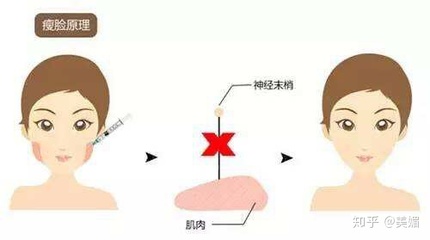 溶脂针和瘦脸针哪个安全