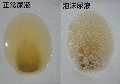 小便有白色泡沫是怎么回事