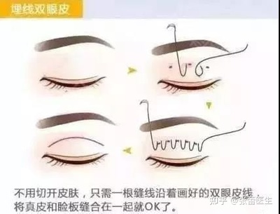 双眼皮有几种做法