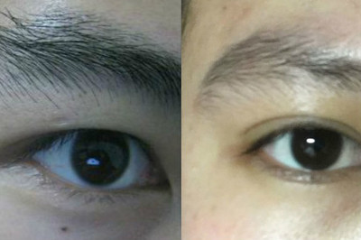 左眼眉毛长痘痘