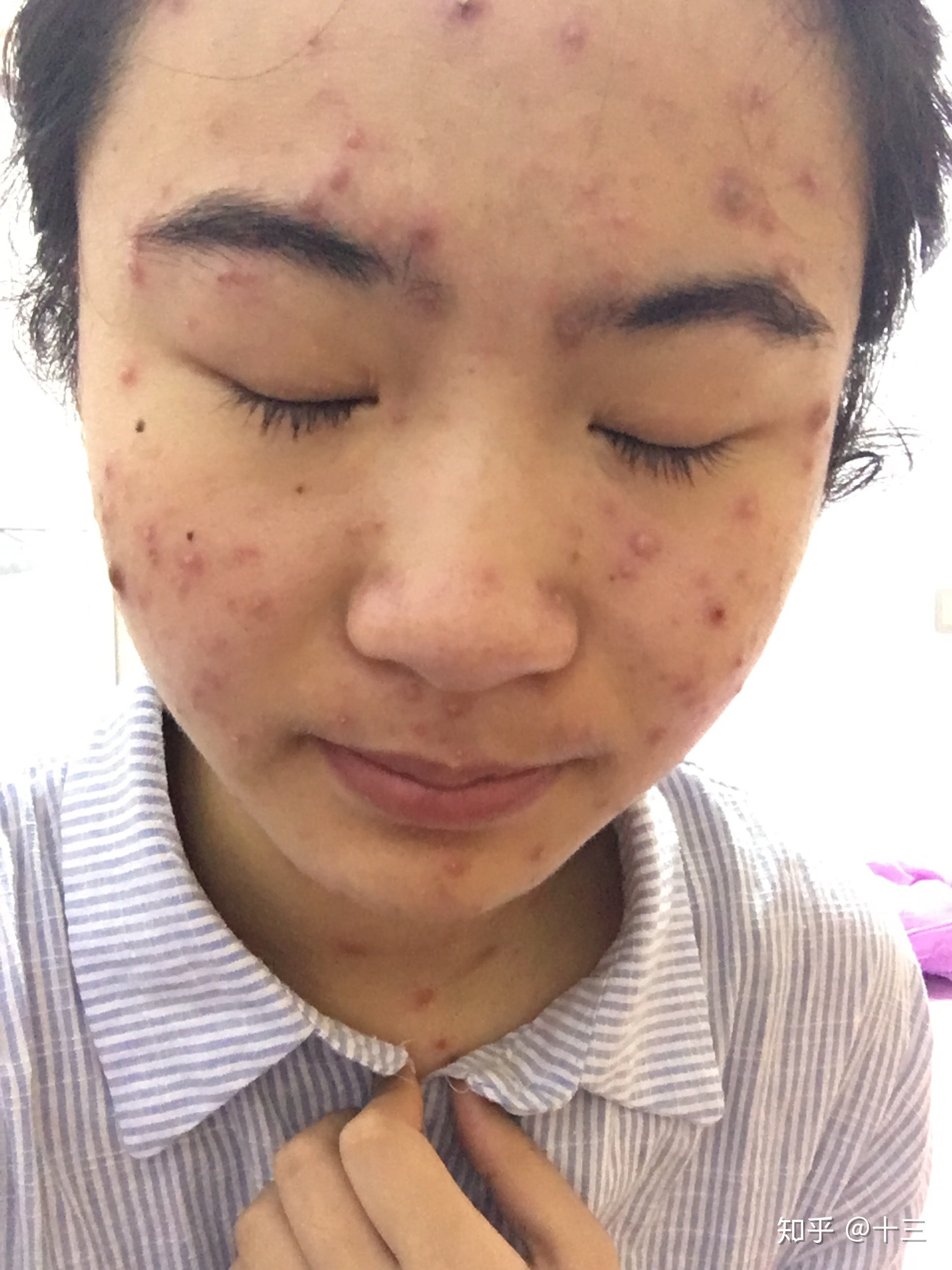 脸上的痘痘变红怎么办