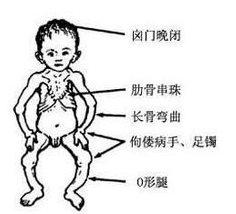 佝偻病怎么治疗效果好