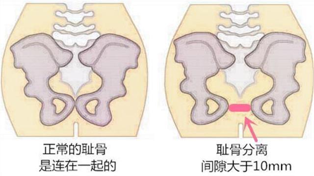 孕妇 耻骨联合分离