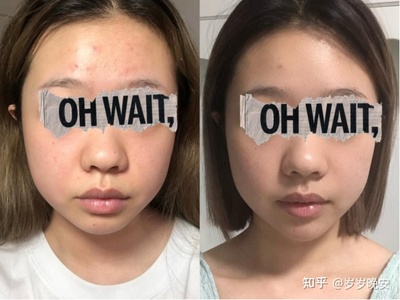 姨妈期起痘痘的原因