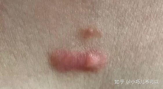 红奶白色痘痘
