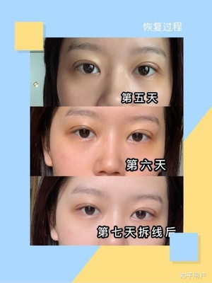 眼角有血块是怎么回事