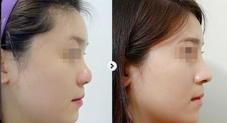 玻尿酸有什么副作用