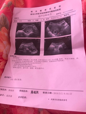 两个月没有胎心