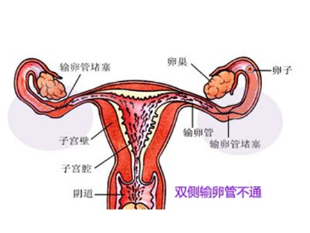 输卵管不通是怎么回事