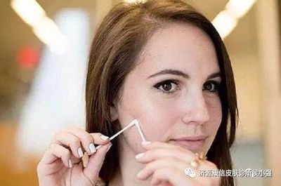 酒精 痘痘