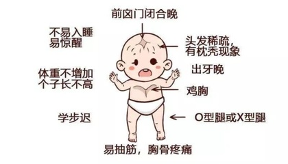 佝偻病怎么治疗效果好