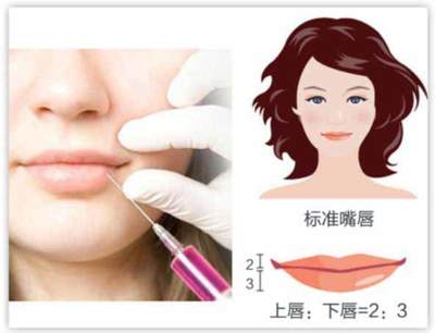 丰唇玻尿酸