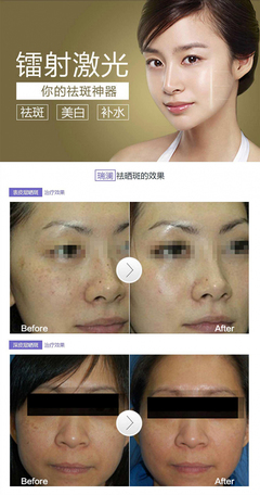 去斑美白要多少钱