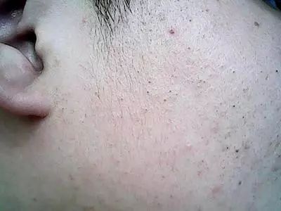 为什么脸上有痘痘男士