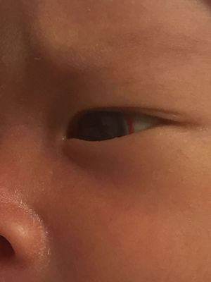 宝宝眼睛有红血丝是怎么回事