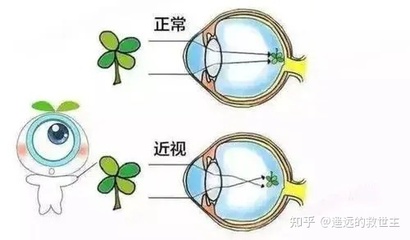 近视镜是凸透镜还是凹透镜