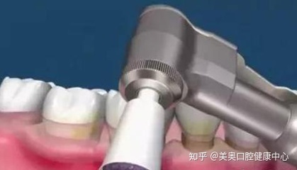 喷沙洗牙