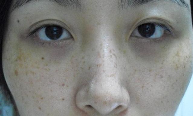 脸颊长斑是怎么回事