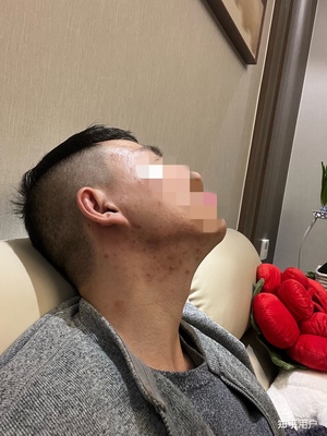 怎样能治好痘痘