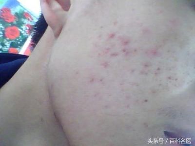 脸色起痘痘怎么排毒