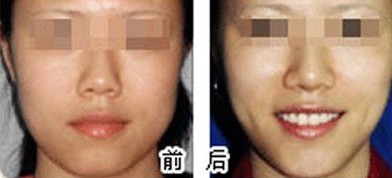 泰州四院做双眼皮如何