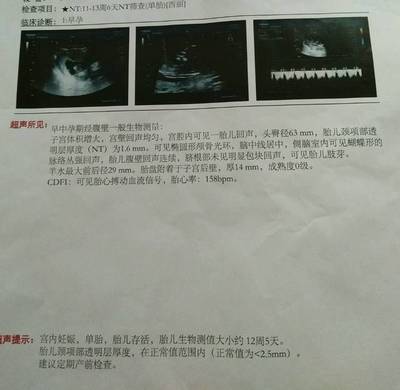 12周胎儿nt值正常范围