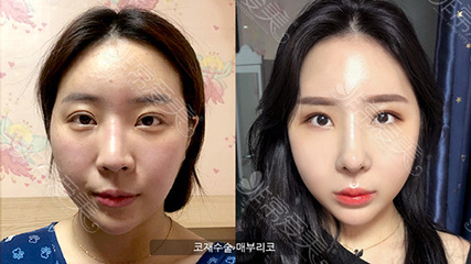 隆鼻整形效果