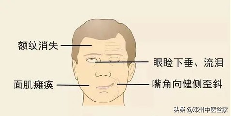 脸部麻是怎么回事