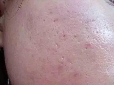 痘痘留下疤痕怎么办