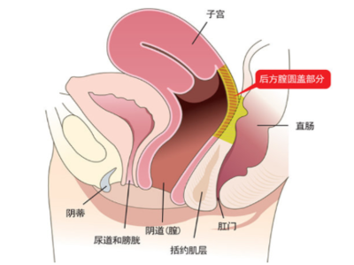 宫颈下垂怎么治疗