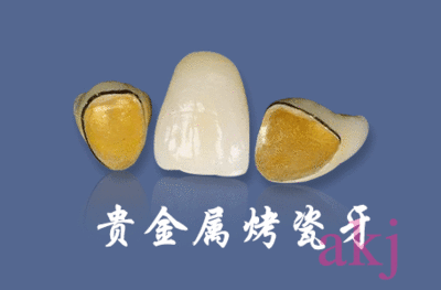 牙齿烤瓷连冠修复