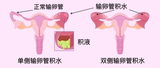输卵管造口术后怀孕率