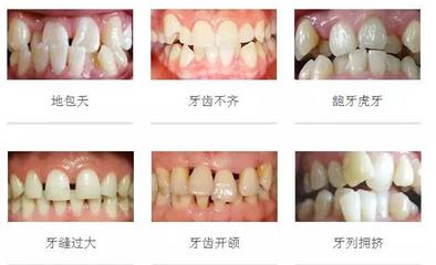牙齿矫正时间要多久