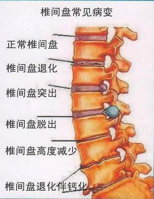 颈椎突出怎么治疗效果好