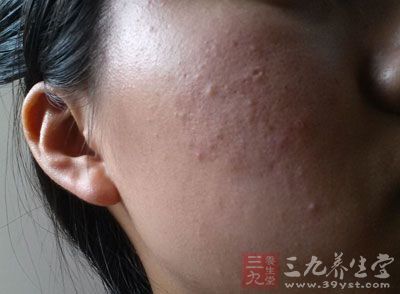 青春痘印怎么去除