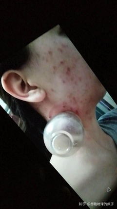 拔火罐的地方长出痘痘