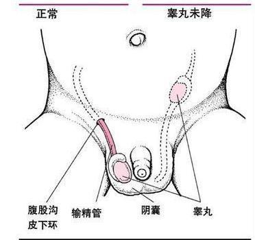 男孩隐睾是怎么回事