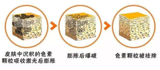 爆破祛斑对皮肤的伤害