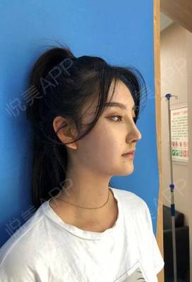 隆鼻7天后拆线疼不疼