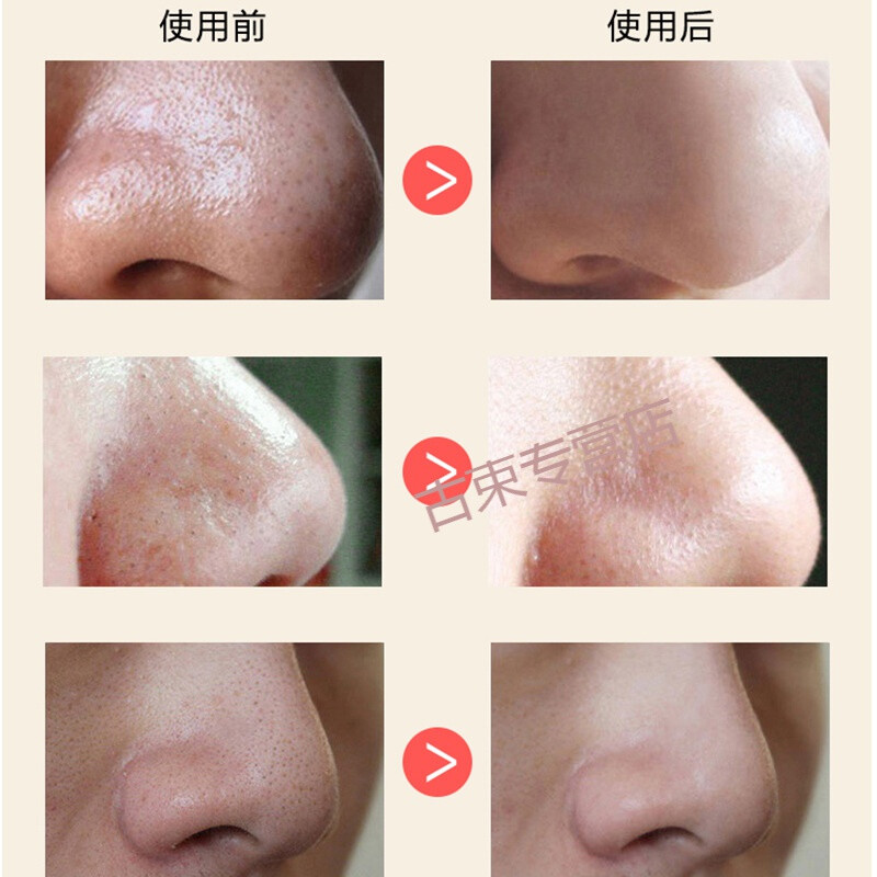 鼻子毛孔收缩