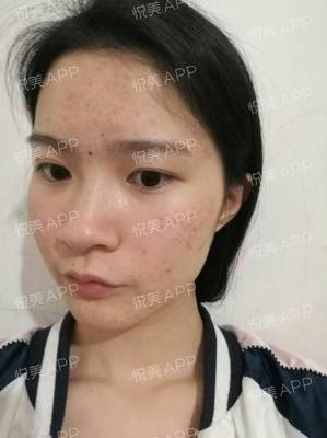 祛痘痘痘印的app软件