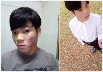 男生脸长痘痘怎么调理