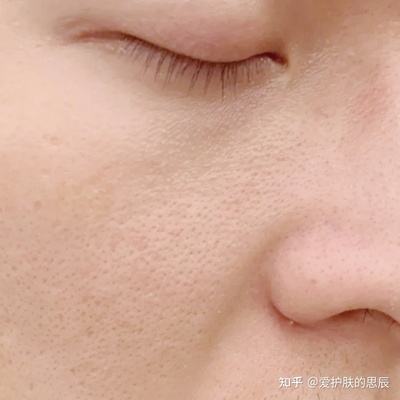 男生脸部毛孔粗大怎么办