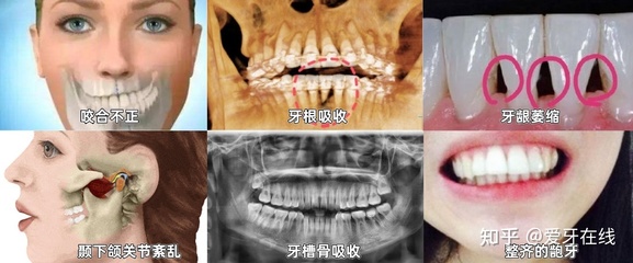 牙齿矫正失败后果