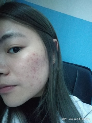 做眉毛脸上起痘痘