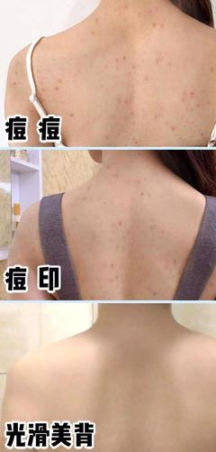 背部出痘痘怎么治疗方法
